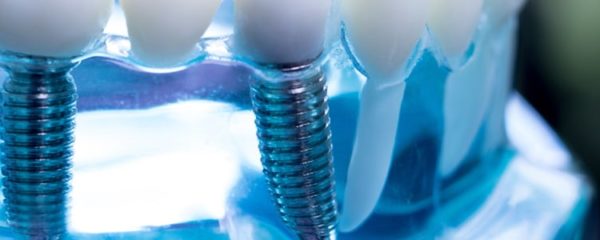 implants dentaires